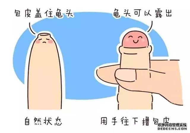 包皮过长